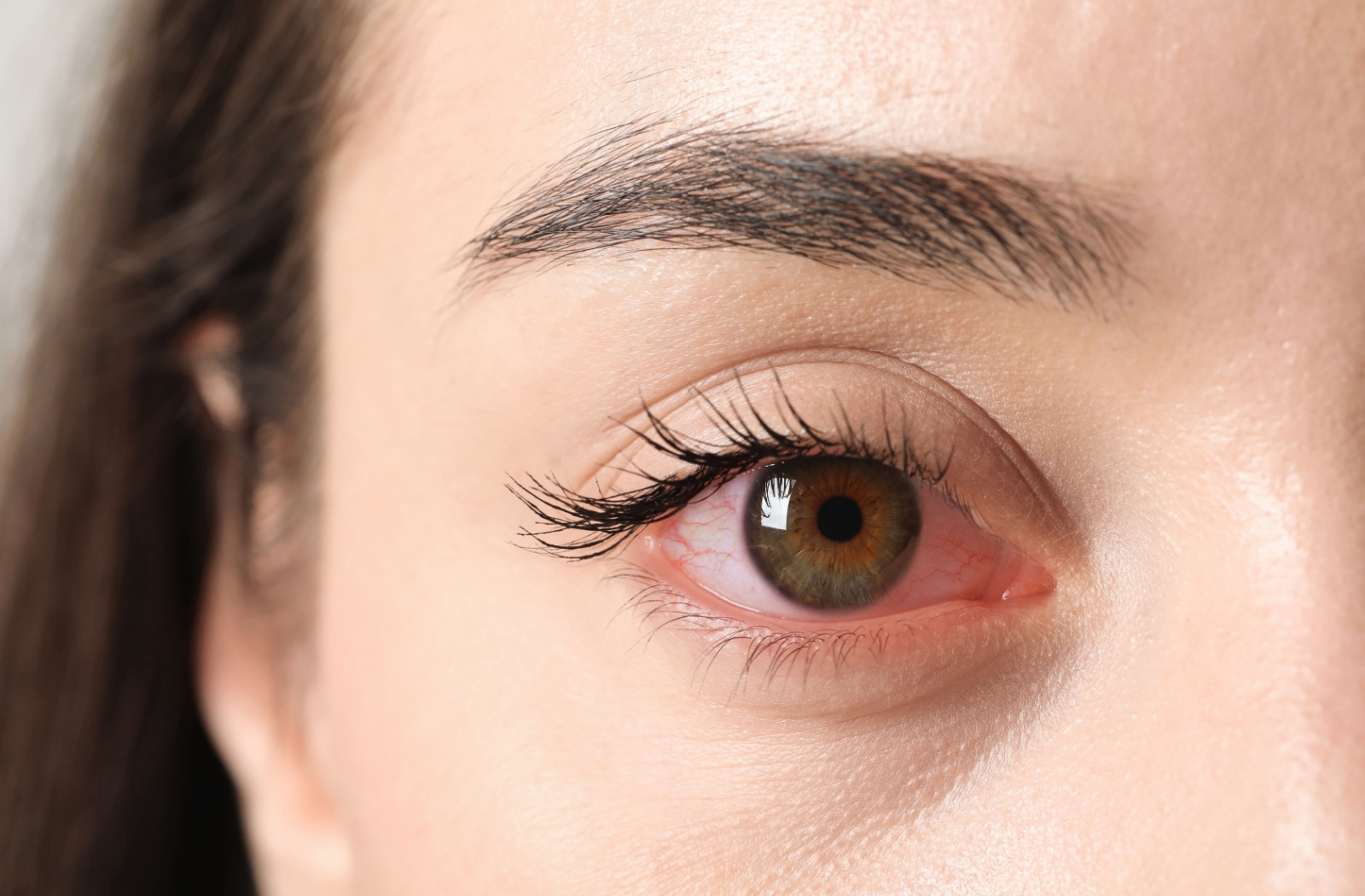 Extreme close-up of an eye that's red from inflammation.
