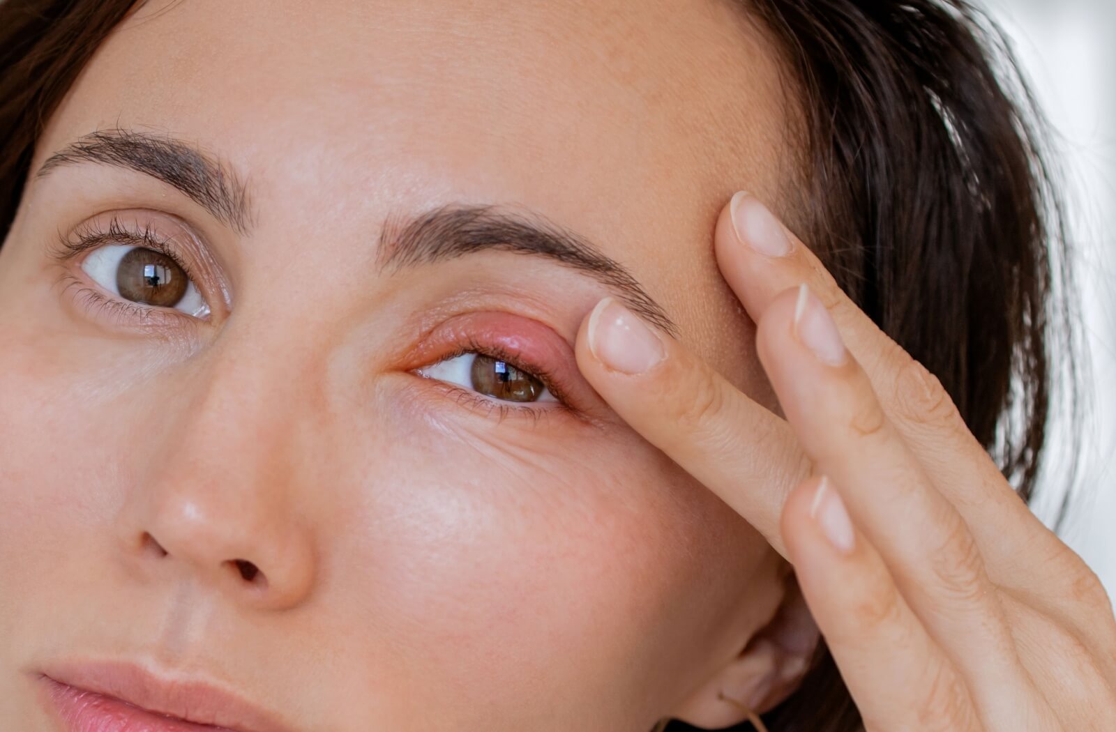 Close-up of a woman touching an inflamed bump on the top of her left eyelid.